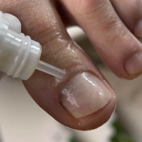 Resultum Onistopix Oil 15 ml, ein regenerierendes Öl für Nägel, die mit Onycholyse behandelt wurden - Фото №2